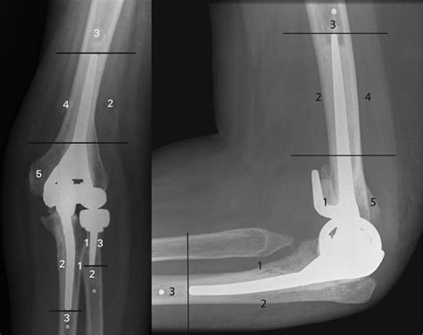Short Term Clinical Results Of Revision Elbow Arthroplasty Using The