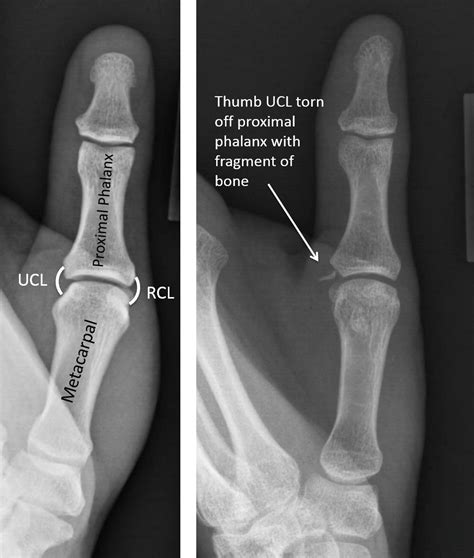 Thumb Sprains Raleigh Hand Surgery — Joseph J Schreiber Md