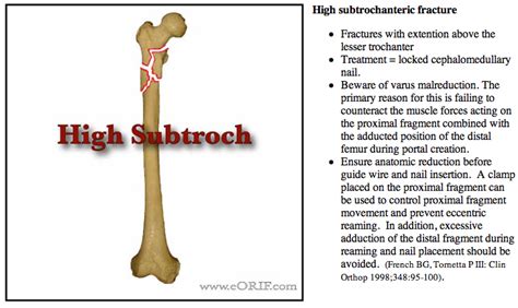 Subtrochanteric Femur Fracture S72.23XA 820.22 | eORIF