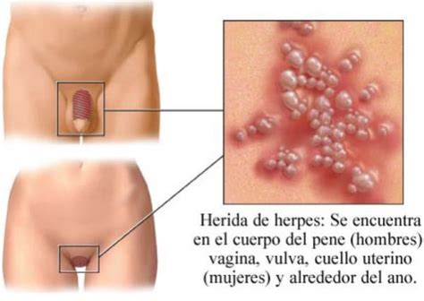 Cómo prevenir el herpes genital 7 pasos