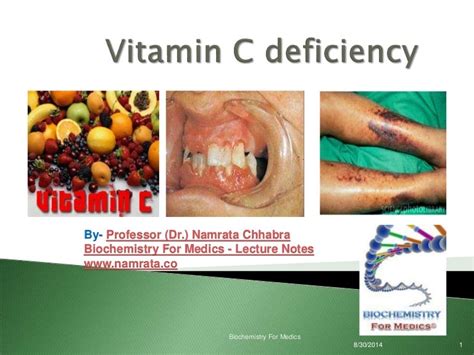 Scurvy Vitamin C Deficiency Ascorbic Acid Deficiency