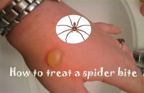 15 Home Remedies To Treat A Spider Bite Quickly At Home