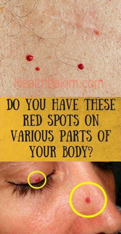 Do You Have These Red Spots On Various Parts Of Your Body Should You