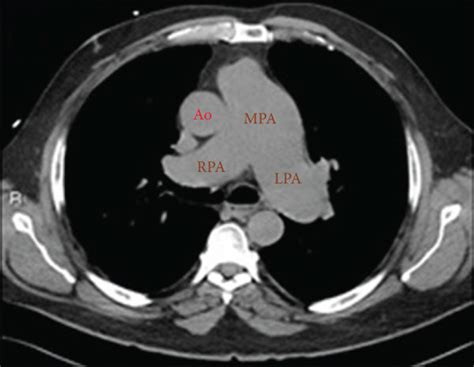 A Ct Scan Showing Main Pulmonary Artery With A Diameter Of 33 Mm In