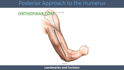 Posterior Approach To The Humerus • Easy Tutorial • Orthofixar 2022