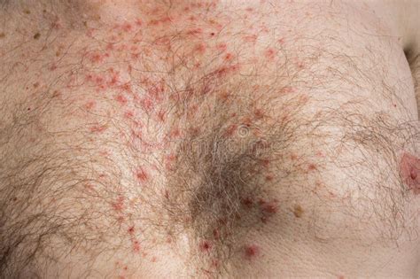 Chest Skin Rash As Drug Side Effect After Surgery Stock Photo Image