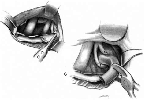Transaxillary First Rib Resection For Thoracic Outlet Syndrome