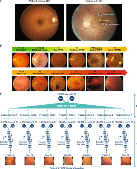 Diabetic Retinopathy Screening The Rise Of Artificial Intelligence In