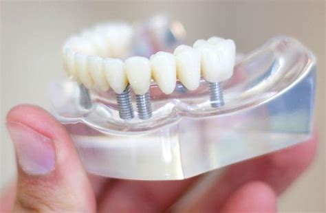 What Is Osseointegration Dental Implants Mills Road Dental Centre