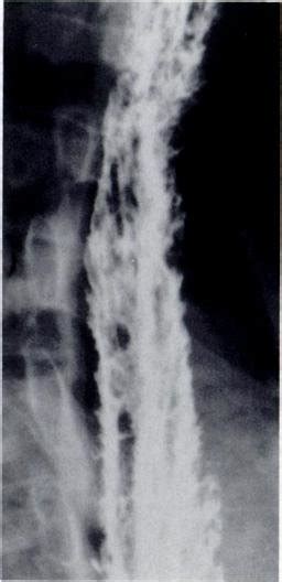 Double Contrast Esophagogram In Patient With AIDS Shows Severe Candida