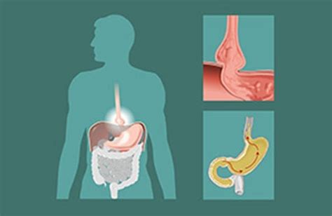 Hiatal Hernia Repair Lap Band Center Of Orange County