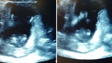 Video Ultrasound Video Shows 14 Week Old Fetus Clapping Abc13 Houston