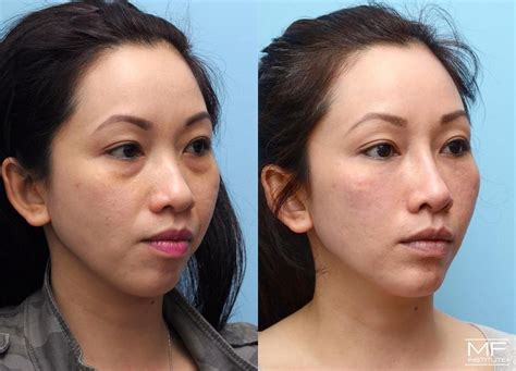 Mfi Lift Liquid Facelift Before And After Photos Patient 375 San