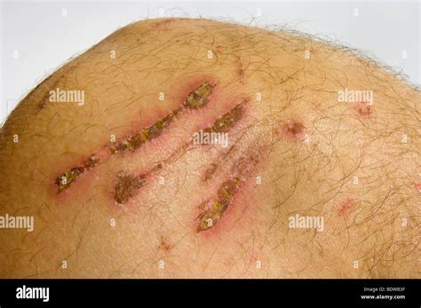 Diver Knee Dermabrasion Hurt Skin Scratch Scuff Abrasion Of Corals