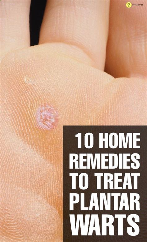 10 Effective Home Remedies To Treat Plantar Warts Plantar Wart Get