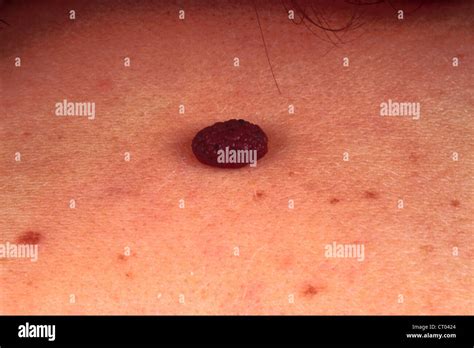 Seborrheic Warts Hi Res Stock Photography And Images Alamy
