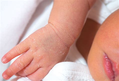 Newborn Skin Peeling Causes Treatment And Prevention