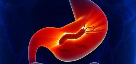 Gastrite aguda causas diagnóstico e tratamento