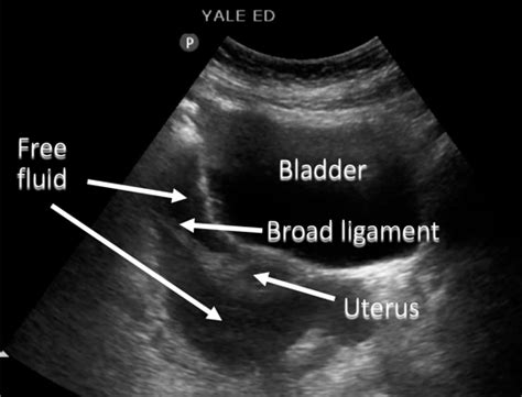 Hi i just had a pelvis ultrasound n the report states: Pelvic Free Fluid | Lesson #106