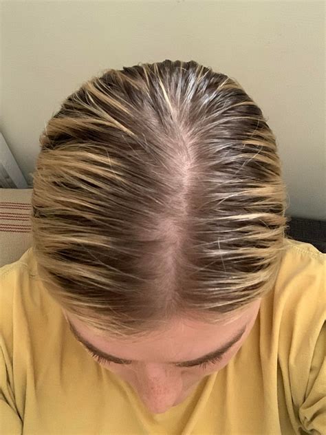 Should I be concerned about this hair loss/thinning? : FemaleHairLoss