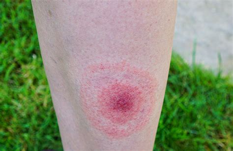 Ticks And Tick Borne Disease Prevention