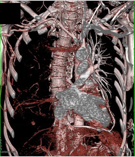 Superior Vena Cava Svc Syndrome With Collaterals In Patient With Non