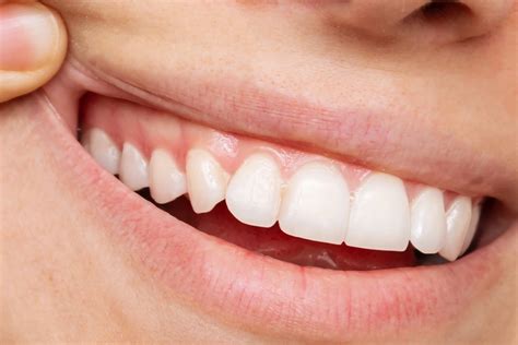 What Do Healthy Gums Look Like Pictures And Action Plan