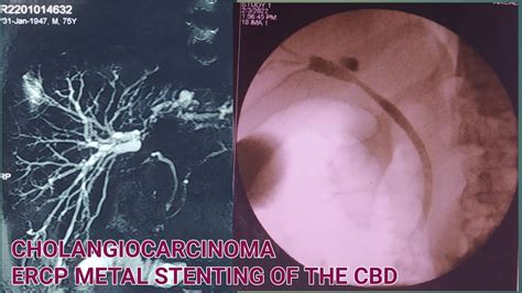 Cholangiocarcinoma Ercp Metallic Stent Placement At Square Hospitals