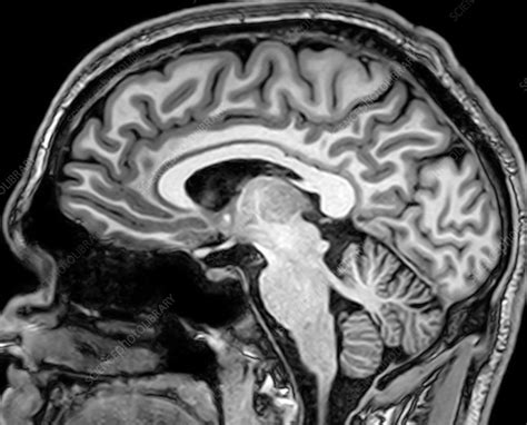 Normal Sagittal Brain Mri Porn Sex Picture