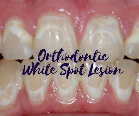 White Spot Lesions On Teeth