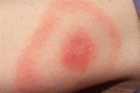 What Is Erythema Migrans Possible Causes And Treatment Evolving World