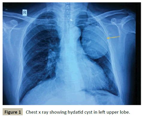 Uncommon Hydatid Cyst In Lung