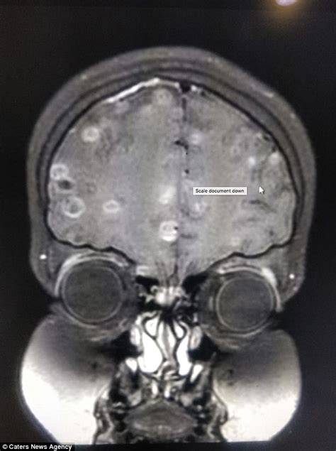 Girl Suffered Seizures After Her Brain Became Infected With Tapeworms