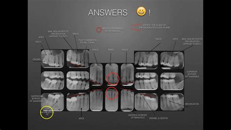 The Full Mouth X Ray Survey Identification And Film Mounting Youtube