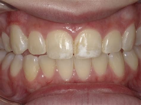 White Spot Treatment Cherry Valley Dental Duvall Wa