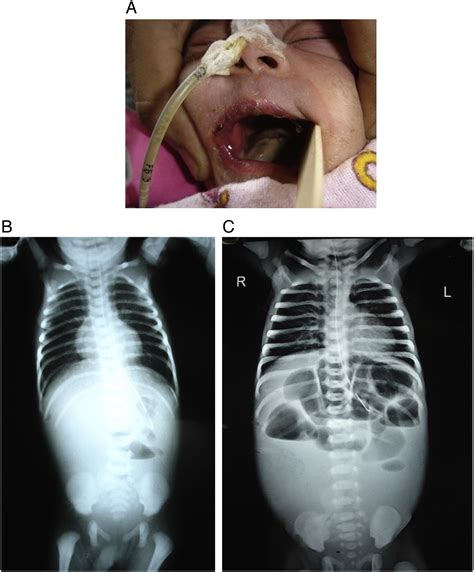 Neonatal Lingual And Gastrointestinal Mucormycosis In A Case Of Low