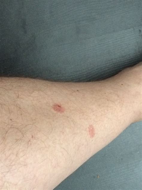Round Red Spots On Legs Pictures Photos