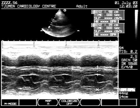 Asymmetric Septal Hypertrophy Definition Causes Symptoms Diagnosis