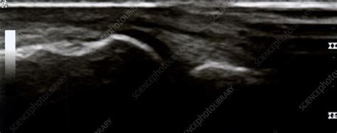 Joint Effusion Ultrasound Stock Image C0393334 Science Photo