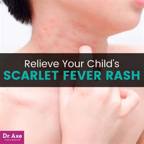 Scarlet Fever Rash Relief 10 Soothing Natural Treatments Dr Axe