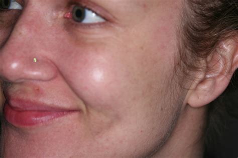 Case Study Cheek Augmentation Facial Rejuvenation Treatments
