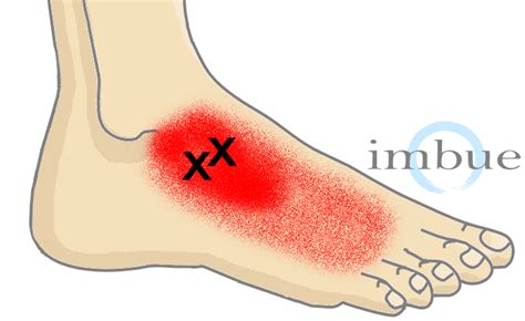 View Foot Muscle Pain Diagram Background Altravoceilblog