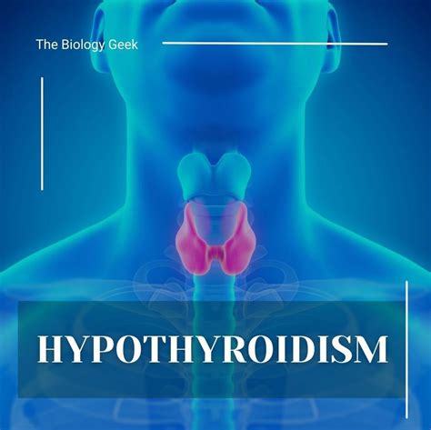 Hypothyroidism Underactive Thyroid Symptoms Causes And T Flickr