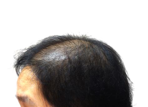 Alopecia areata is a form of alopecia (hair loss). Alopecia cicatriziale: nelle donne afro-americane aumenta ...
