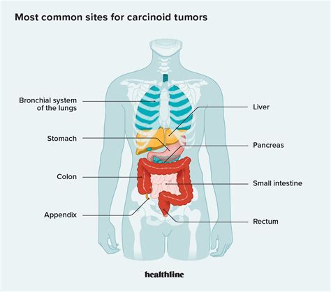 carcinoid tumors symptoms diagnosis treatment and outlook