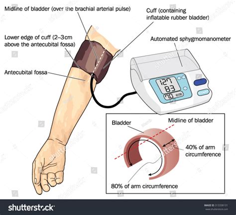 Blood Pressure Cuff On Arm Over The Brachial Pulse Attached To