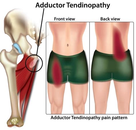 Adductor Tendinopathy Tendonitis Causes And Treatment Sportnova Uk