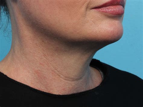 Coolsculpting And Exilis For Double Chin Non Invasive Neck Reduction
