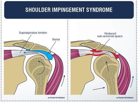 Bursitis of the shoulder (impingement syndrome) occurs when there is swelling and redness between the top of the arm bone and the tip of the shoulder. Shoulder Impingement - Irritable Shoulder Pain and Physiotherapy | Palm Beach Physiotherapy Centre