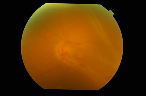 Globe Perforation With Periocular Anaesthesia Needle Retina Image Bank